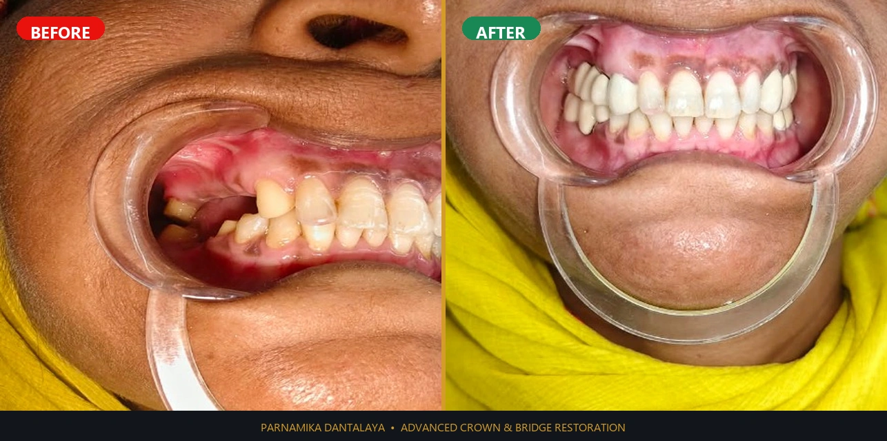 Crown & Bridge Restoration Before & After Result